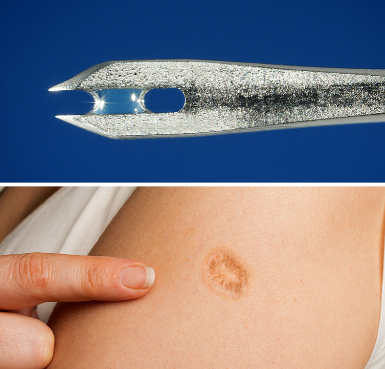 Smallpox vaccine scar
